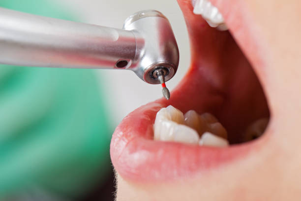 Best Emergency Dentist for Lost Fillings or Crowns in Kenbridge, VA